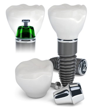 dental implants kenilworth coventry
